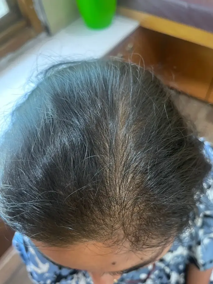 Female Pattern Baldness case 6 after treatment